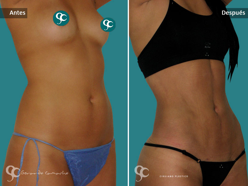 Testimonio Marcacion Abdominal Colombia